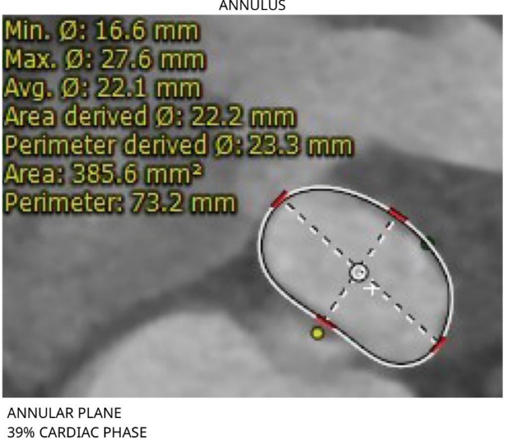 AlkashkariWail's tweet photo. 75yF critical BAS type 0 MPG70, BSA1.5, severe LVH, Memb septum 4mm.
#medtronic_evolute 26mm, #cusp_overlap #commisural_alignment pre-dil & post-dil. Final MPG5,trace AI,sinus with nice coronary engagement with LJ3.5.
@rashaalbawardy @DrAlsaiediAB @AlrahimiJ @bogamisa @MogneeA https://t.co/7wmc4rpG5J