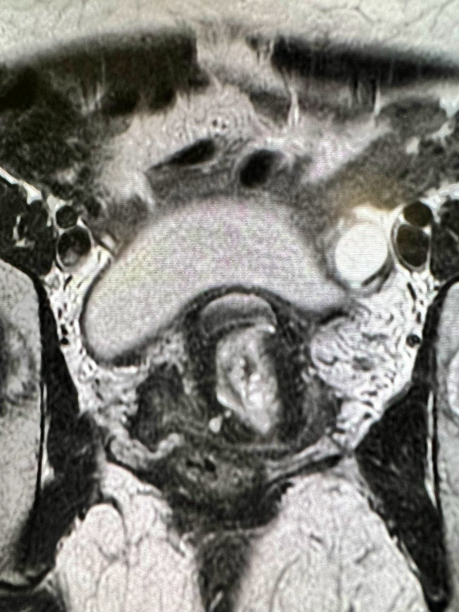 jabaizan's tweet photo. 40-years old woman with permanent spotting after a previous cesarean section 4 years ago…que será,será?👀👀 @sediabdomen @ESUR_JN @EsurOffice @SocAbdRadiology @RadiologiaCasos https://t.co/BatwMibjQB