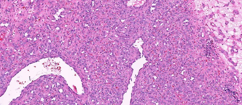 25 yo F w/ ulcerated nodule on toe. Your diagnosis? Can you also identify the fun incidental bonus finding (near base of biopsy)? WSI digital slides: kikoxp.com/posts/3746. Answer: kikoxp.com/posts/9640 #Pathology #dermpath #dermatology #dermatologia #dermtwitter #BSTpath