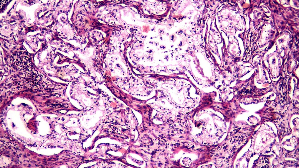Amany Hassan (@dramanyhassany1) on Twitter photo (1/2) #gynpath Non-HPV associated cervical carcinoma, gastric type with mets in pelvic LNs. The lymph node👇. <a href="/AnneMillsMD/">Anne Mills</a> <a href="/CPHpath/">Carlos Parra-Herran MD</a> <a href="/DrEstherAdler/">Esther Adler, MD</a> <a href="/JojoPathAdvntrs/">Elizabeth Kertowidjojo, MD, PhD, MPH</a> <a href="/KayParkMD/">Kay J. Park</a> <a href="/OBGYNPATH/">Katja Gwin M.D.</a> @NatalieBanet <a href="/Mvgs1706/">Monika Vyas</a> <a href="/padmapathology1/">Padma Priya J</a> <a href="/nucleololailo/">Carlos Miguel Ruiz</a> <a href="/DrBMcGinn/">Barry McGinn</a> <a href="/kis_lorand/">Lorand Kis</a> <a href="/drtugcecay/">Tuğçe Çay</a> (1/2) #gynpath Non-HPV associated cervical carcinoma, gastric type with mets in pelvic LNs. The lymph node👇. <a href="/AnneMillsMD/">Anne Mills</a> <a href="/CPHpath/">Carlos Parra-Herran MD</a> <a href="/DrEstherAdler/">Esther Adler, MD</a> <a href="/JojoPathAdvntrs/">Elizabeth Kertowidjojo, MD, PhD, MPH</a> <a href="/KayParkMD/">Kay J. Park</a> <a href="/OBGYNPATH/">Katja Gwin M.D.</a> @NatalieBanet <a href="/Mvgs1706/">Monika Vyas</a> <a href="/padmapathology1/">Padma Priya J</a> <a href="/nucleololailo/">Carlos Miguel Ruiz</a> <a href="/DrBMcGinn/">Barry McGinn</a> <a href="/kis_lorand/">Lorand Kis</a> <a href="/drtugcecay/">Tuğçe Çay</a>