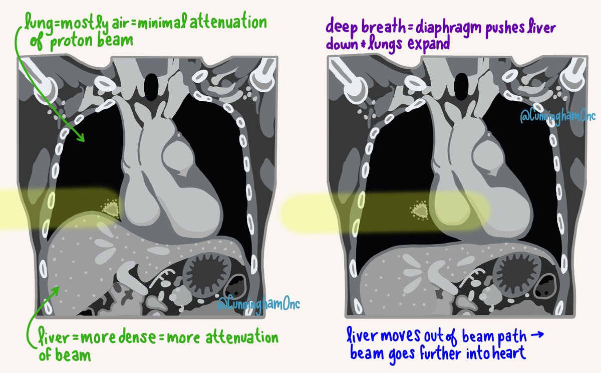 Simplified diagram reflecting how anatomical differences in proton beam path impacts dose distribution #medphys #roedu #radonc #rtt #dosimetry