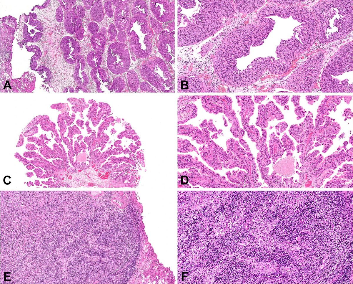 Indiana Association of Pathologists (@indianapath) on Twitter photo Risk assoc with variant histology in HGT1 bladder carcinoma compared with conventional urothelial carcinoma and other aspects to consider when reporting percentages of variant histology
#gupath #pathtwitter
๐ link.springer.com/article/10.100โฆ
<a href="/AlessiaCim/">Alessia Cimadamore</a> <a href="/LiangChengMD/">Liang Cheng, MD</a> <a href="/ESP_Pathology/">European Society of Pathology (ESP)</a> Risk assoc with variant histology in HGT1 bladder carcinoma compared with conventional urothelial carcinoma and other aspects to consider when reporting percentages of variant histology
#gupath #pathtwitter
๐ link.springer.com/article/10.100โฆ
<a href="/AlessiaCim/">Alessia Cimadamore</a> <a href="/LiangChengMD/">Liang Cheng, MD</a> <a href="/ESP_Pathology/">European Society of Pathology (ESP)</a>