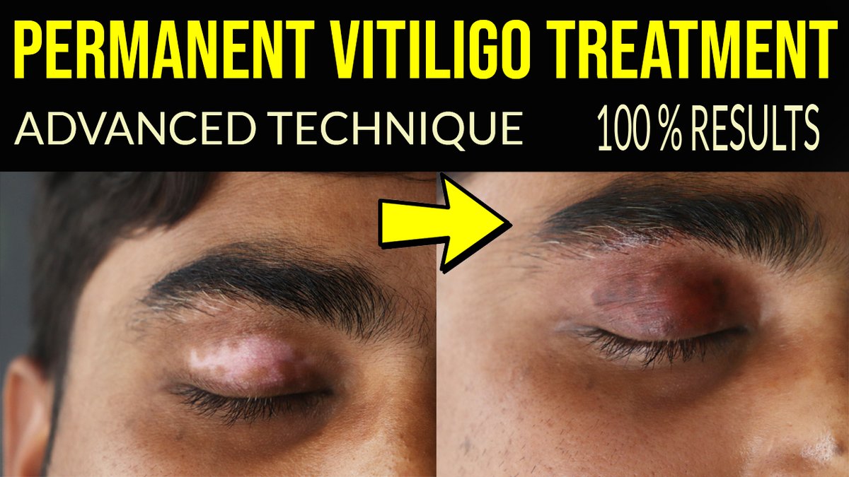 Micro Vitiligo (@MicroVitiligo) / Twitter