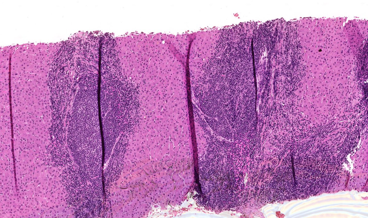 Liver biopsy, older patient

#HPBpath #GIpath #Pathresidents