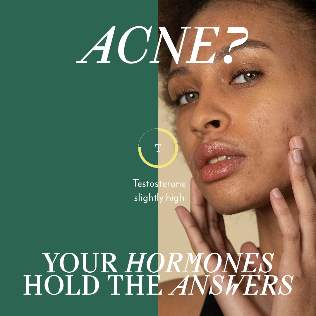 You don't have acne because you don't swap out your pillowcase for a new one every night or don't drink gallons of water a day, #itsyourhormones