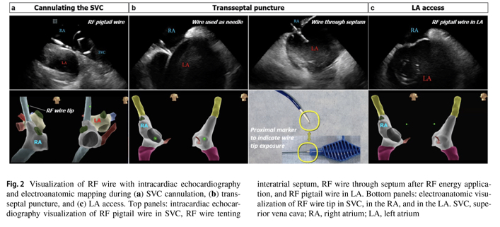 JICE_EP's tweet photo. 🚨 New day and new #freeread article in #JICE. @MRazminia @HanyDemo investigate efficacy and safety of fluoroless left atrial access for RF and CB ablations using a the VersaCross RF wire transseptal system. ⬇️⬇️⬇️
https://t.co/bCwHq0Okr0
#EPeeps #CardioTwitter #medtwitter https://t.co/T8mrlXNEI5