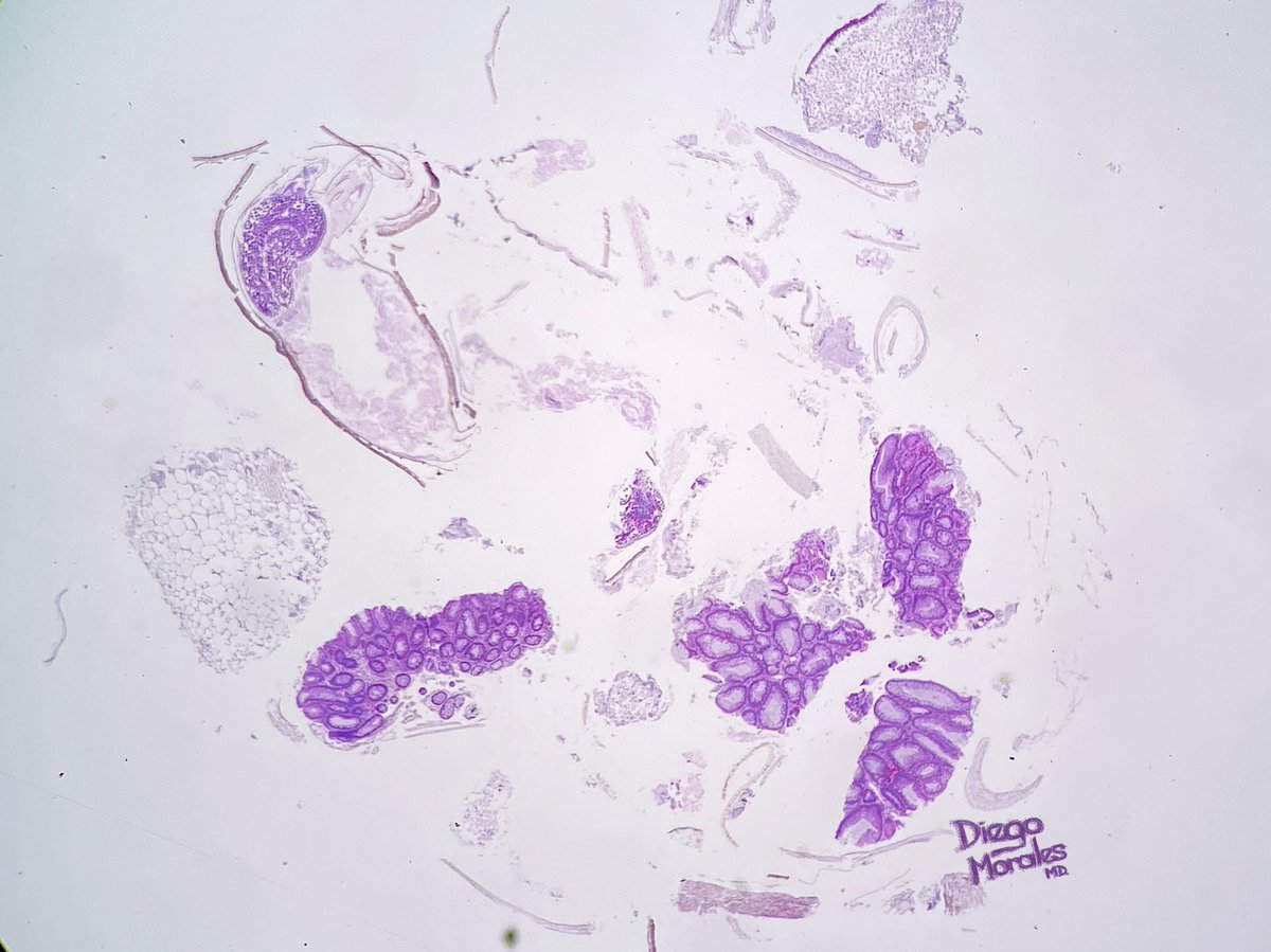 Alternaria conidium in vegetable tissue from a colonic polyp biopsy.

Ubiquitous, usually seen as saprophytic contaminant. Present in soil, plants and air.

Careful with the salad!!! 🥗🥙!

#PathTwitter #GIpath  #tooprettynottoshare  #JoyForMorfology #FreudeAnDerMorphologie