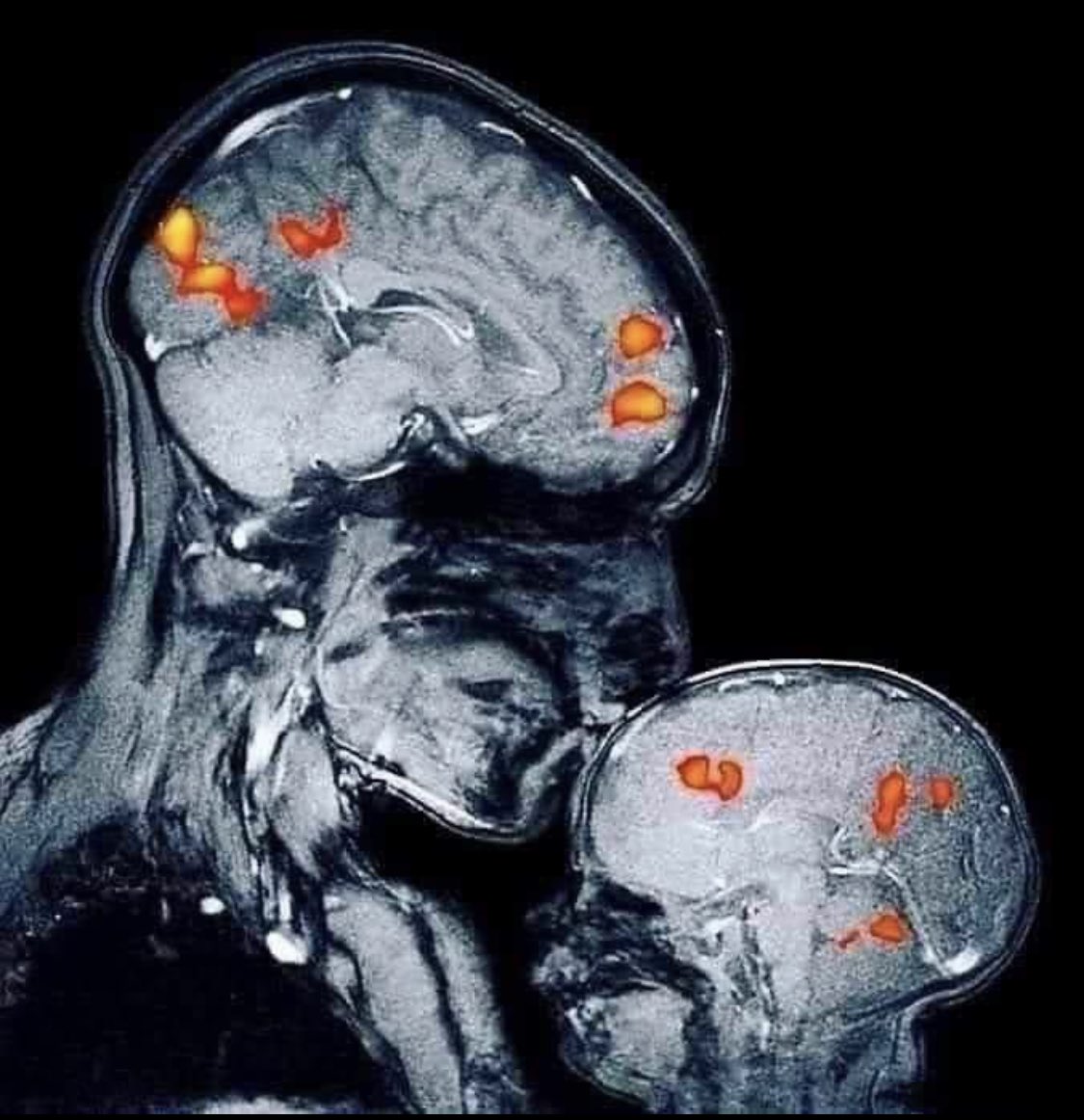 Omdat we dit wel even kunnen gebruiken: liefde in beeld bij deze MRI van een moeder die haar zoontje kust! (Thanks to <a href="/rebecca_saxe/">Rebecca Saxe</a>)