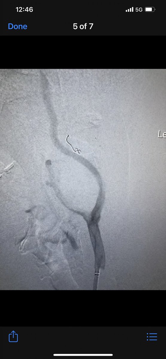 Carotid body tumor embolization in the surgery center with removal tomorrow in the OR