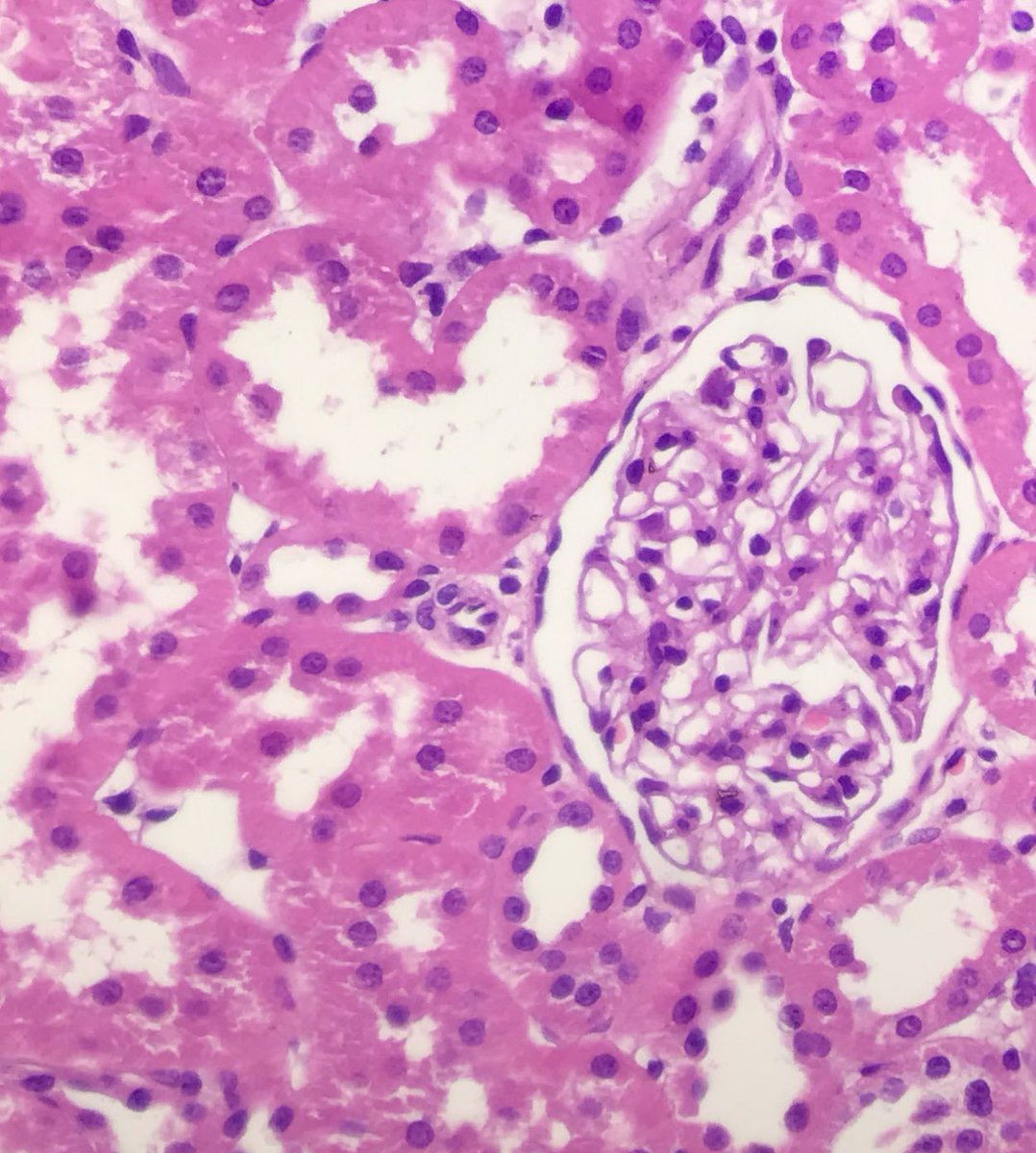 lariphd's tweet photo. a lovely tubule injury 💕 https://t.co/thHxs6jjiF