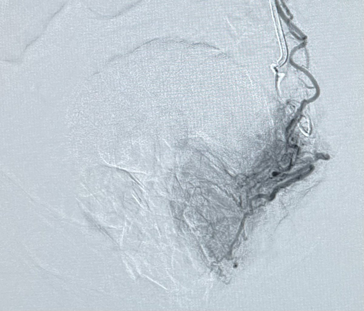 PAE after failed Urolift. You can still the clips from Urolift if you look closely. Smallest prostate I’ve done yet at 65 g. Do you ever worry about embolizing the seminal vesicles <a href="/AriIsaacsonMD/">Ari Isaacson</a> <a href="/SandeepBaglaMD/">Sandeep Bagla MD</a> ? <a href="/MCRadiologists/">Medical Center Radiologists</a>