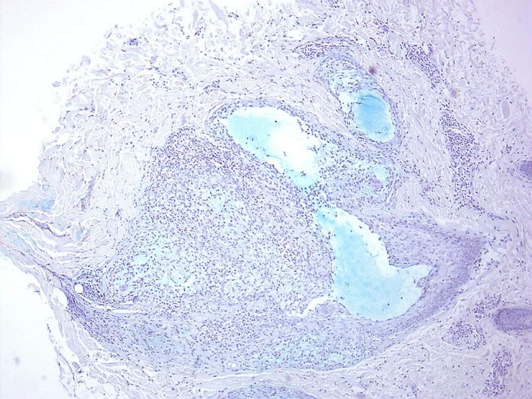 GeronimoJrLapac's tweet photo. F, 30yo
#dermpath #pathology https://t.co/pyjrDL2Yds