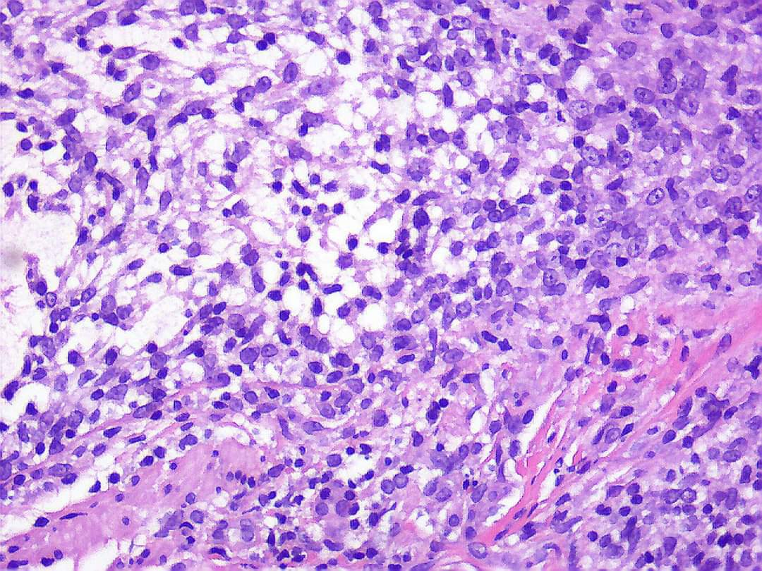 GeronimoJrLapac's tweet photo. F, 30yo
#dermpath #pathology https://t.co/pyjrDL2Yds