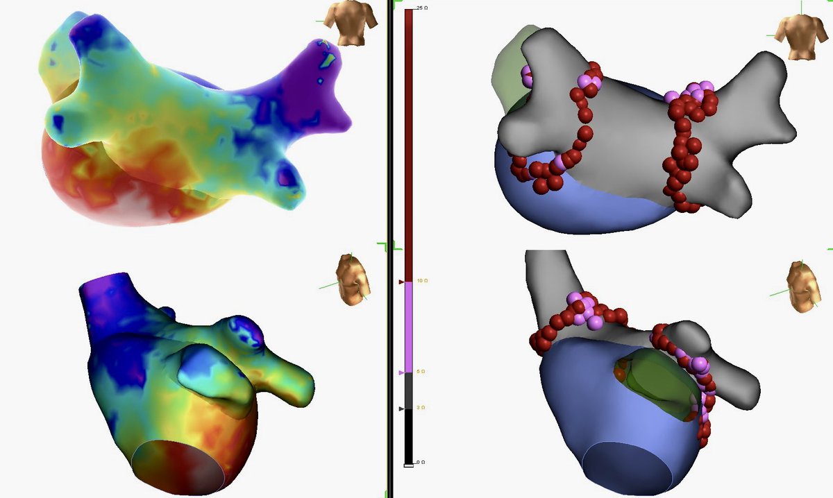 georgecrowell's tweet photo. Methodically placed #AutoMark lesions guided by biophysics lead to single pass pulmonary vein isolation. Size = Stability, Color = Ω ⬇️. #TactiCathSE #AbbottAF @AbbottEP @B_Naz_MD @cmv040 https://t.co/HFZ6c9XRaf