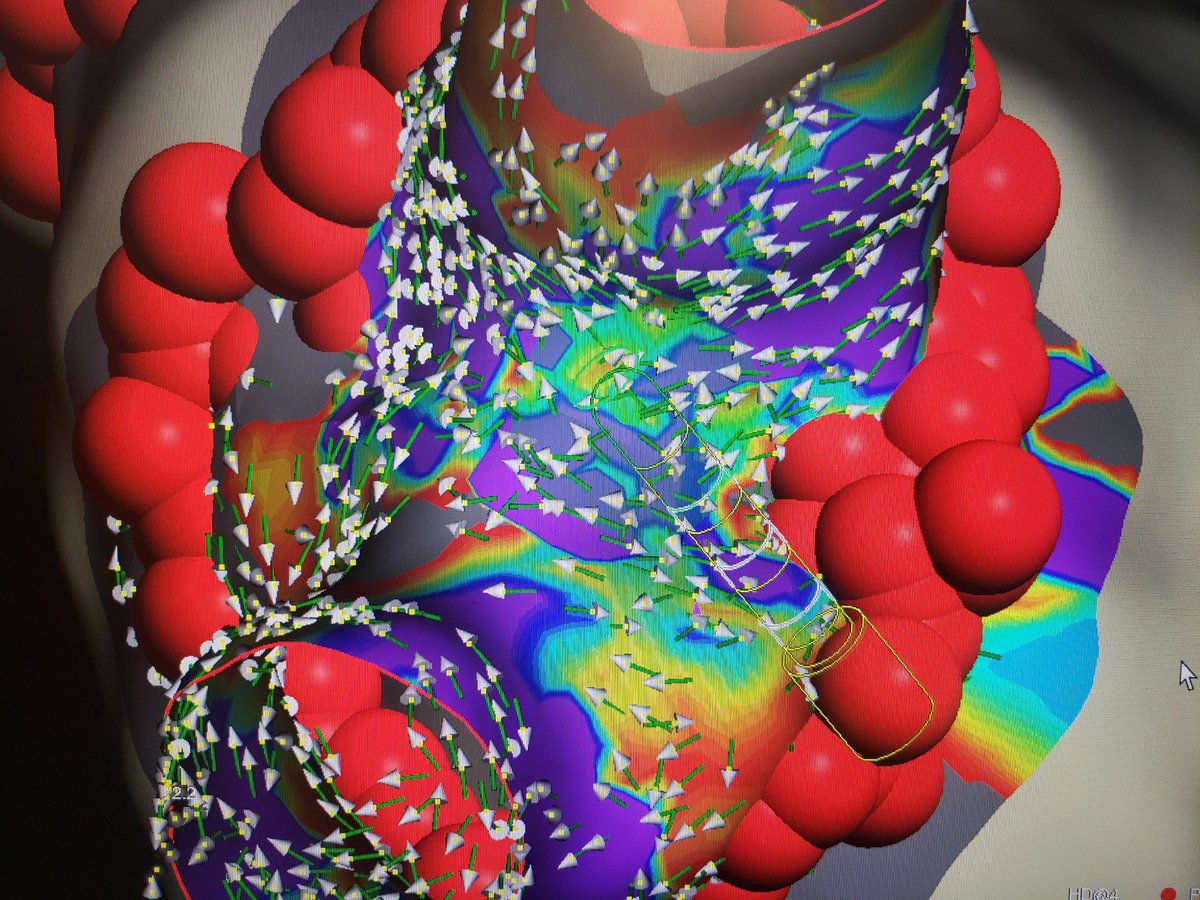 HISrefrPVC's tweet photo. Great use of OT during voxel mode!! After first pass on the right veins, remap with OT showed a suspected epicardial connection at the Carina. One burn=silence!! @AbbottCardio #OnlyWithOT #EnsiteX #TrueEGMs @eggheded @EisenhowerHeal @asanchezEP @DrCJBradley @netta_doc @Hapa_EP https://t.co/pTLvJPforr