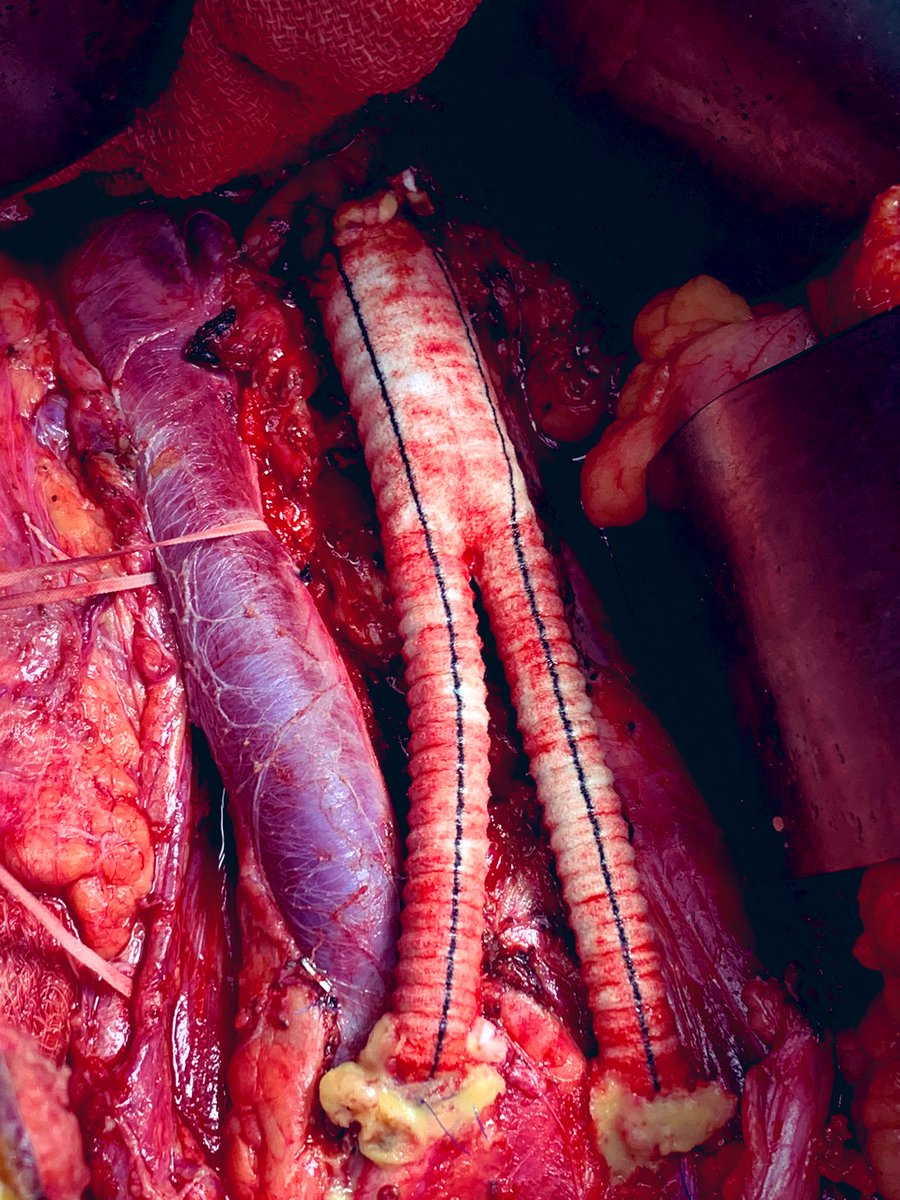Combine a urologist and a vascular surgeon