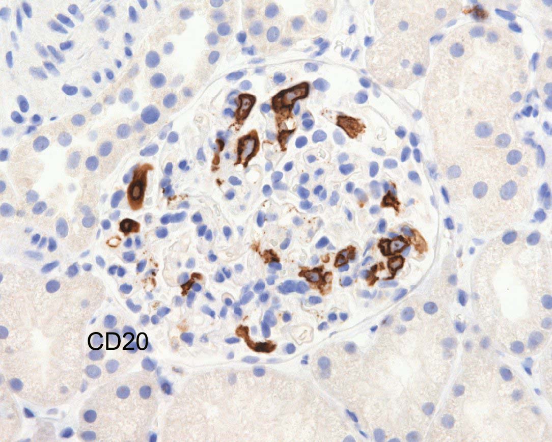 Don't see this every day....Intravascular large B-cell lymphoma. These can be really sneaky.