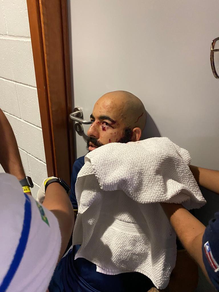 pedrosentose's tweet photo. Esse é o estado do goleiro Danilo Fernandes. Ele deu muita sorte de não ter perdido a visão por conta dos estilhaços. https://t.co/wcKjbgdFvK