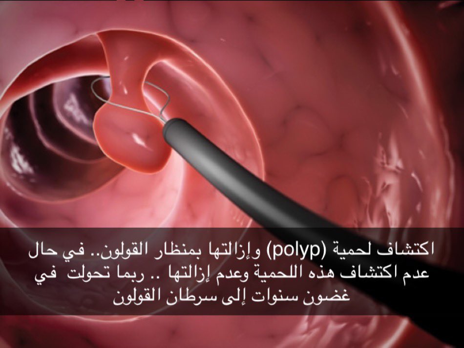 DrAhmedAlShehri's tweet photo. ٨٥٪ من #سرطان_القولون تنشأ من لحميات حميدة تتطور بمرور السنوات إلى سرطان
فحوص الكشف المبكر لسرطان القولون تهدف للكشف عن هذه اللحميات وإزالتها قبل أن تتحول لسرطان
الكشف المبكر عن #سرطان_القولون لا يكتشف السرطان في مرحلة مبكرة فحسب، بل يقي من السرطان بإزالة اللحميات المسببه له ! https://t.co/NflCagAwAp