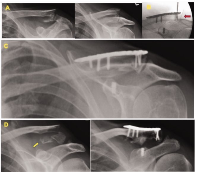 Does locking plate and coracoid anchor augmentation for unstable lateral end clavicle fractures reduce the need for plate removal and improve patient reported outcome. journals.sagepub.com/doi/full/10.11…