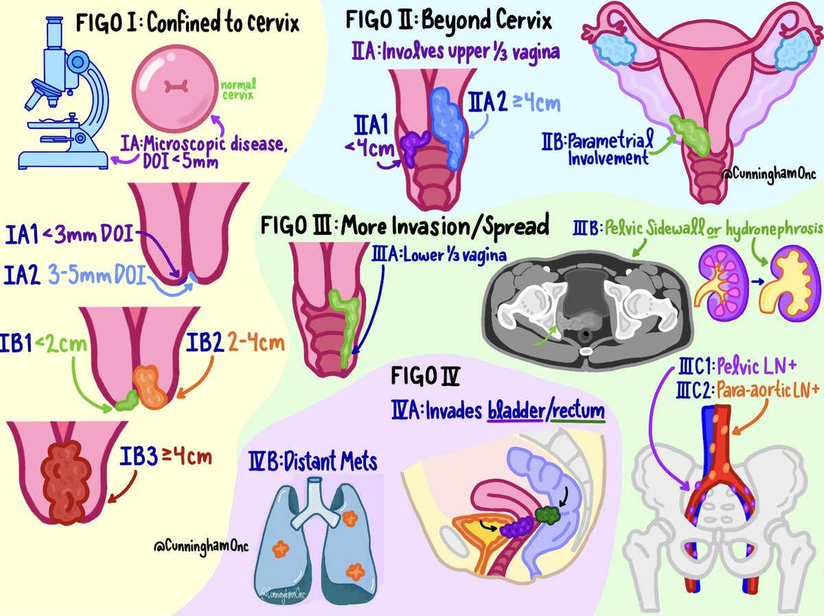 Simplified illustration for #cervicalcancer staging
 #meded #radonc #gynonc #gyncsm #roedu #obgyn #oncology #cancer