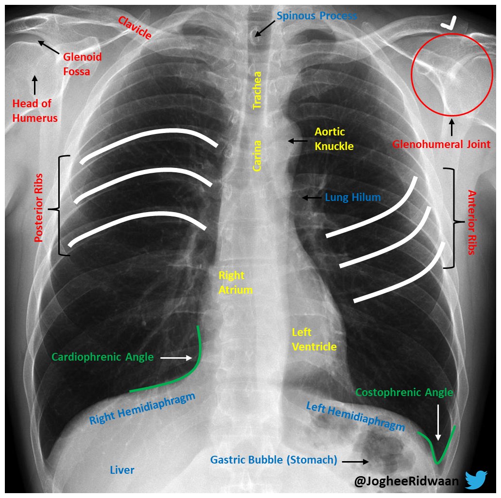 normal chest xray labeled