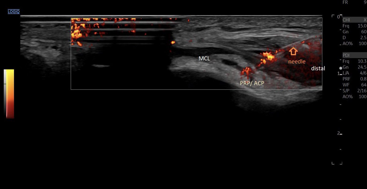 SportklinikBern's tweet photo. #partialrupture of the distal #mcl with #ultrasoundguidedinjection #arthrexacp - #mskus #pocus #pocushub #logiqE10 https://t.co/QpPT0pHkcC