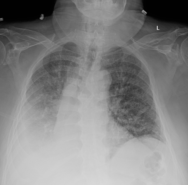 MayoPCCM's tweet photo. CXR with with right-sided #opacities and #pleuraleffusion. Confirmed on CT chest, also bilateral pulmonary #nodules.
🤔 Any testing you would like? https://t.co/W7cPUKex2w