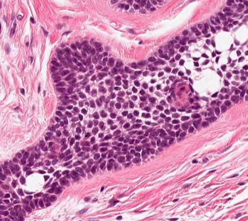 GershonMD's tweet photo. 45 year old male presenting with jaw swelling, malocclusion. 
imaging shows a mandibular mass.

1. Describe the histology.
2. What's the diagnosis?
3. What's a common mutation in this mass?

Answers in 1 week!
Very on-theme for this month's MEDSKL! #ENTpath #otolaryngology #MedEd https://t.co/b8Sm9K6fSu