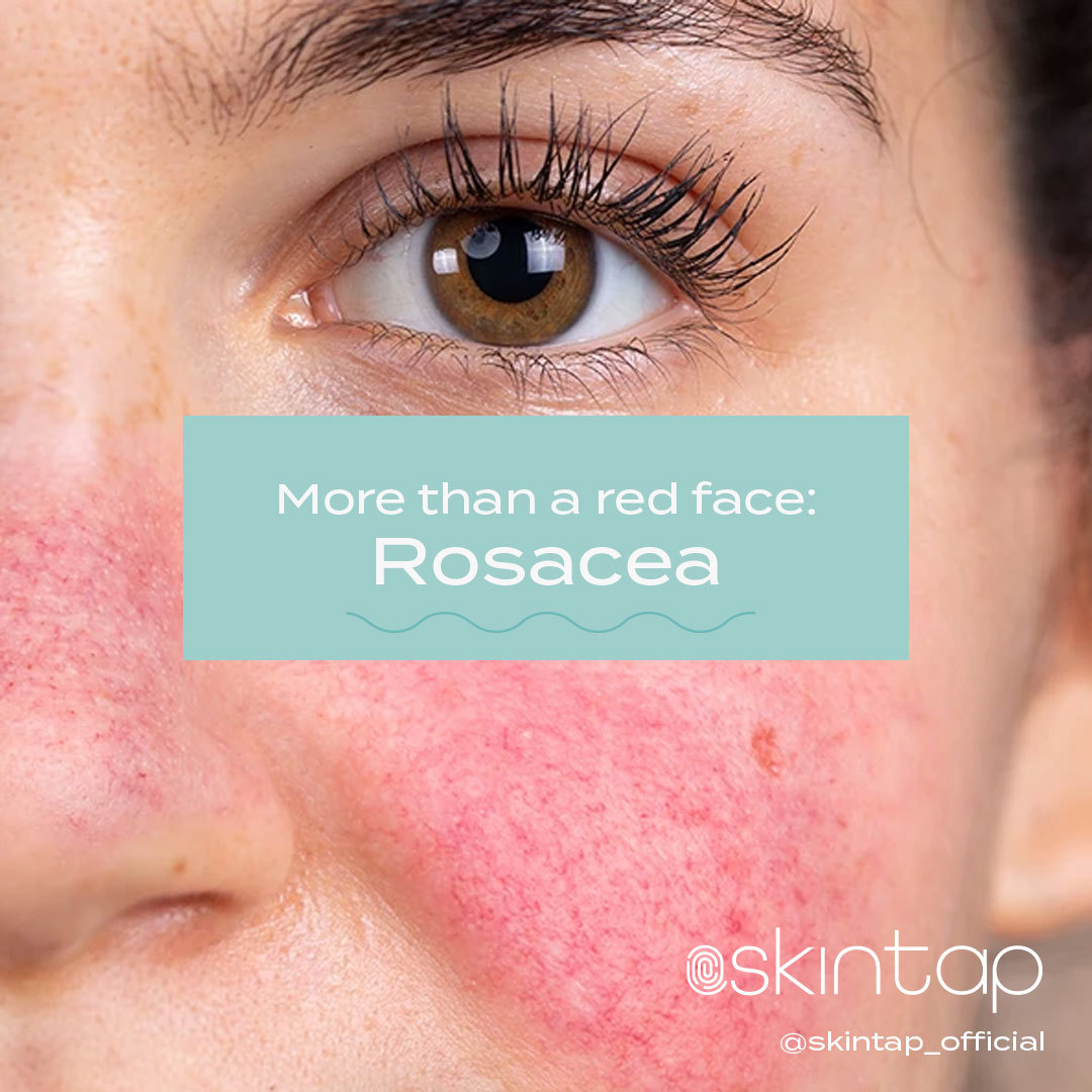 SkintapOfficial's tweet photo. Did you know there's are four subtypes of rosacea and it’s possible to have more than one type at a time AND each one requires a different treatment?!💊

Read the full blog post learn more: More than a red face: Rosacea https://t.co/lt0mqTsyKv