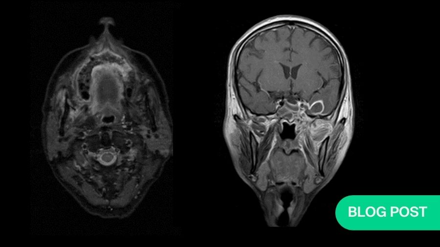 AO CMF (@aocmf_official) on Twitter photo #New on the #AOCMF Guest Blog 📖
"Lessons from CAM (Covid Associated #Mucormycosis): A Memoir of a Maxillofacial Surgeon" ➡️ fal.cn/3mt29
#COVID19 #infection #COVID <a href="/_tk_live/">Taranjit Kaur</a> #New on the #AOCMF Guest Blog 📖
"Lessons from CAM (Covid Associated #Mucormycosis): A Memoir of a Maxillofacial Surgeon" ➡️ fal.cn/3mt29
#COVID19 #infection #COVID <a href="/_tk_live/">Taranjit Kaur</a>