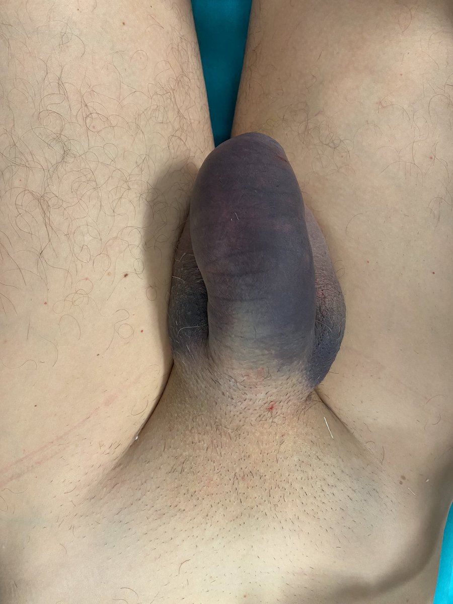 uroCosta's tweet photo. Pay attention to your hot nights…. Both corpora and urethra rupture @uroLeslieLicari @SapienzaUrology @SIU_Italia https://t.co/X6EoAGZJgZ