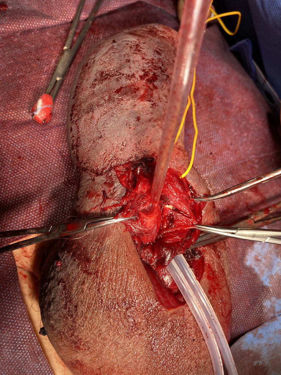 uroCosta's tweet photo. Pay attention to your hot nights…. Both corpora and urethra rupture @uroLeslieLicari @SapienzaUrology @SIU_Italia https://t.co/X6EoAGZJgZ