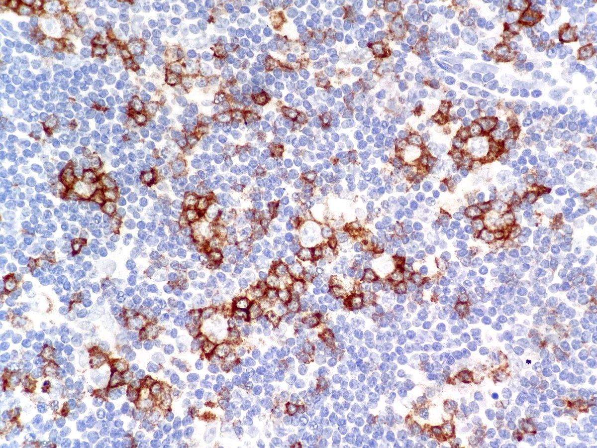 Nodular lymphocyte predominant Hodgkin lymphoma.

Immunostain for PD1 demonstrates T-cell rosettes surrounding tumor cells.
