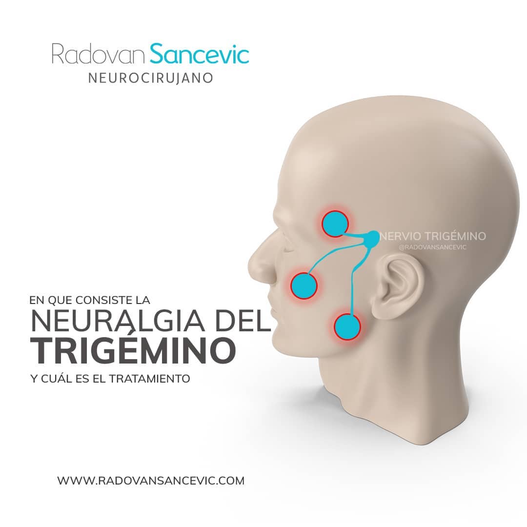RadovanSancevic's tweet photo. El nervio trigémino le da la sensibilidad a la mitad de la cara del individuo. Tiene tres ramas y dependiendo de la rama que esté afectada, el dolor se ubica bien sea en la frente, en los cachetes o en la mandíbula. https://t.co/lqxJfgzRM1