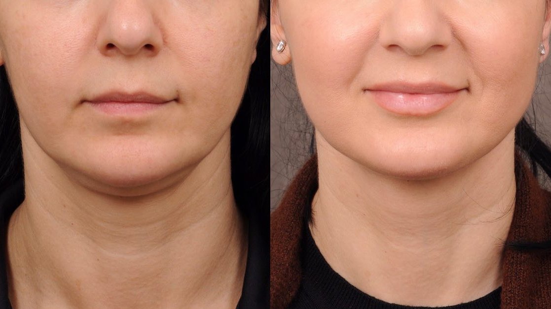 DrBenTalei's tweet photo. WEEKEND LIFT
An internal deep plane neck lift with no need for skin excision. Profound Radiofrequency was also performed on the face and neck to improve the skin quality as you can see in the photo.
#necklift #weekendlift #deepplanenecklift #profoundrf https://t.co/KH5CMXCfxz