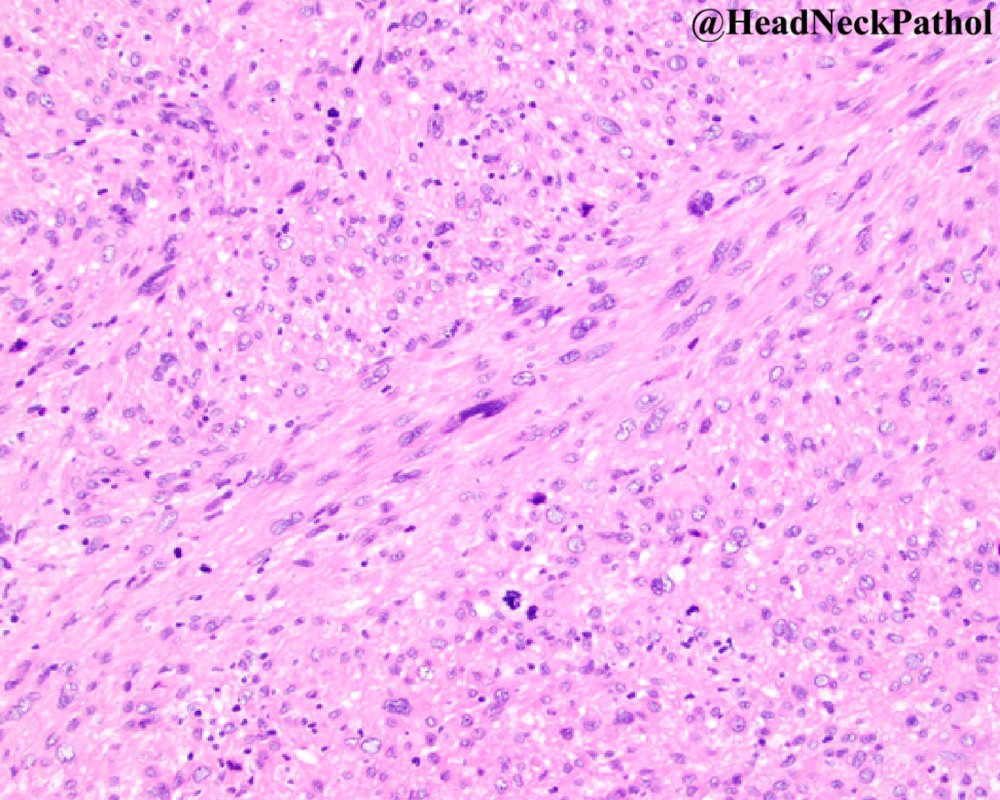 Leiomyosarcoma of the Nasal Cavity and Paranasal Sinuses: A Case Report and Comprehensive Review of the Literature
By SS Sam, B Stewart, E Nasri, ME Leon &amp; EM Duarte
rdcu.be/cHLyk
#HeadNeckPathol #HNPJ #HeadandNeckPath #Pathology #ENTPath #PathologyTweet