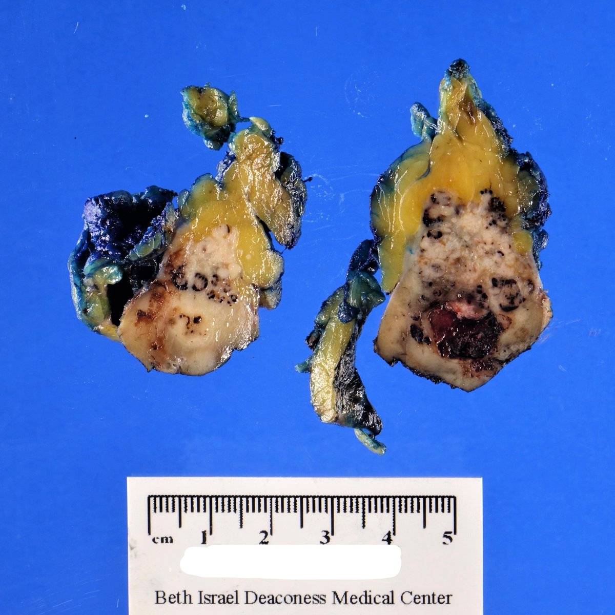 BIDMC Pathology (@bidmcpath) on Twitter photo 🔰 Interesting Case Of The Week 🔰
➡️ 60-70y with incidentally found renal mass
➡️ What gross features are noteworthy on this partial nephrectomy?
🔜 Microscopic pics to follow, meanwhile please comment on your thoughts/impressions!
<a href="/pembeoltulu/">Pembe Oltulu, MD</a> #GUpath #pathology 🔰 Interesting Case Of The Week 🔰
➡️ 60-70y with incidentally found renal mass
➡️ What gross features are noteworthy on this partial nephrectomy?
🔜 Microscopic pics to follow, meanwhile please comment on your thoughts/impressions!
<a href="/pembeoltulu/">Pembe Oltulu, MD</a> #GUpath #pathology