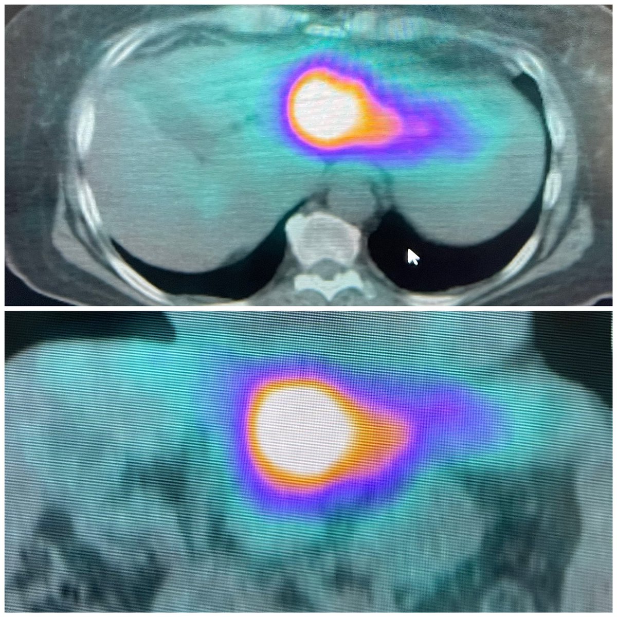 Ahmed Kamel MD, PhD, FSIR (@ahmed_kamel_ir) on Twitter photo Left lateral hepatic lobe HCC supplied by two & three segmental arteries treated with high dose Y90. Fusion images show complete coverage of the tumor & SPECT CT targeted tumor dose #personalized #dosimetry #y90 #radioembolization <a href="/UTHouston_IR/">UT Houston_IR</a> <a href="/UTHradiology/">UTHealth Houston Radiology</a> <a href="/memorialhermann/">Memorial Hermann</a> Left lateral hepatic lobe HCC supplied by two & three segmental arteries treated with high dose Y90. Fusion images show complete coverage of the tumor & SPECT CT targeted tumor dose #personalized #dosimetry #y90 #radioembolization <a href="/UTHouston_IR/">UT Houston_IR</a> <a href="/UTHradiology/">UTHealth Houston Radiology</a> <a href="/memorialhermann/">Memorial Hermann</a>