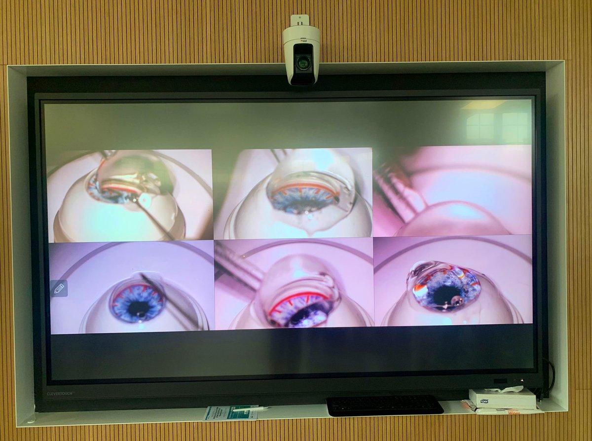 MartaPazosMD's tweet photo. I curso de Iniciación a la cirugía de #glaucoma 👁 con microbypass trabecular iStent Inject W. Gracias a tod@s por vuestra gran participación y a @GlaukosCorp por hacerlo posible ☺️ #teachingglaucoma #microrec #glaucomasurgery #bestteamever #teamwork #MIGS @ClinicITraininC https://t.co/EY4wZWNVhi