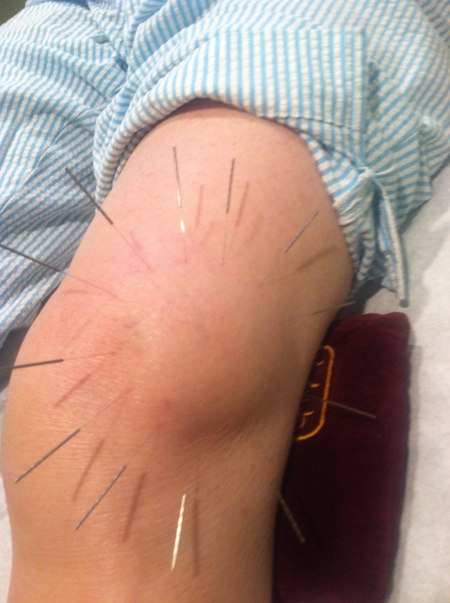 ChasAcupuncture's tweet photo. This is a technique called “Surround the dragon” where the needles are slid under a mass or swelling. 
Charleston Acupuncture is accepting new patients! To schedule your appointment with Treayor Smith call, 843-806-9402. 
#charlestonacupuncture #acupunctureinjuries #TCM https://t.co/nLmvlfa5tZ