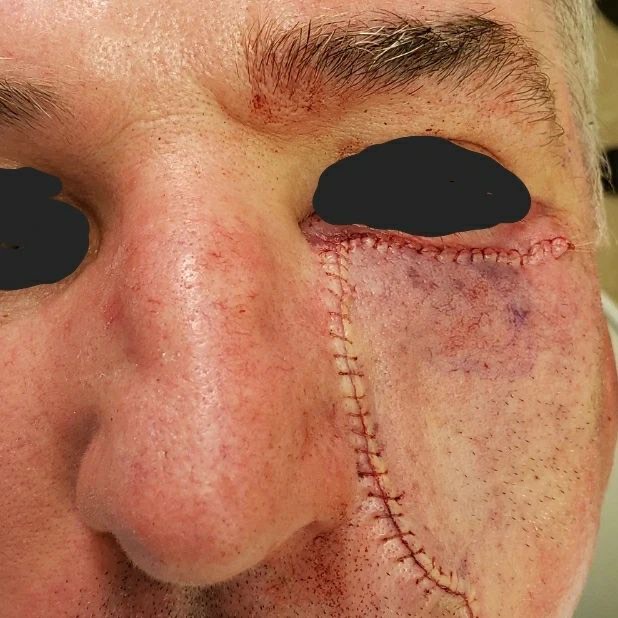 MohsCollege's tweet photo. #FlapFriday- This patient underwent Mohs surgery for a Basal cell carcinoma of the left lower eyelid. The deep defect was repaired with an inferiorly based rotation flap. In order to prevent ectropion, or pulling the eyelid downward, multiple tacking sutures were placed. https://t.co/30VbQxGH1Y