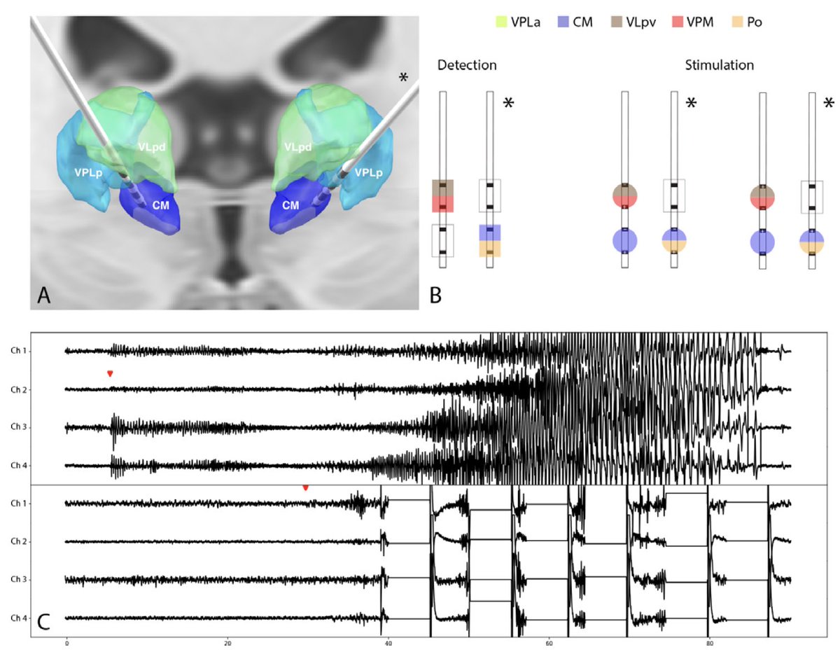 Lead-DBS (@leaddbs) on Twitter photo Exciting case series on responsive neurostimulation of the CM thalamus in epilepsy by <a href="/RMarkRichardson/">Mark Richardson MD PhD</a>, <a href="/ndsisterson/">Nathaniel D. Sisterson</a>, @VasKokkinos, Alexandra Urban & <a href="/NingfeiL/">Ningfei Li</a>:
4 patients > 75%–99% reduction in seizure frequency with decreased duration and severity.
jnnp.bmj.com/content/early/… Exciting case series on responsive neurostimulation of the CM thalamus in epilepsy by <a href="/RMarkRichardson/">Mark Richardson MD PhD</a>, <a href="/ndsisterson/">Nathaniel D. Sisterson</a>, @VasKokkinos, Alexandra Urban & <a href="/NingfeiL/">Ningfei Li</a>:
4 patients > 75%–99% reduction in seizure frequency with decreased duration and severity.
jnnp.bmj.com/content/early/…