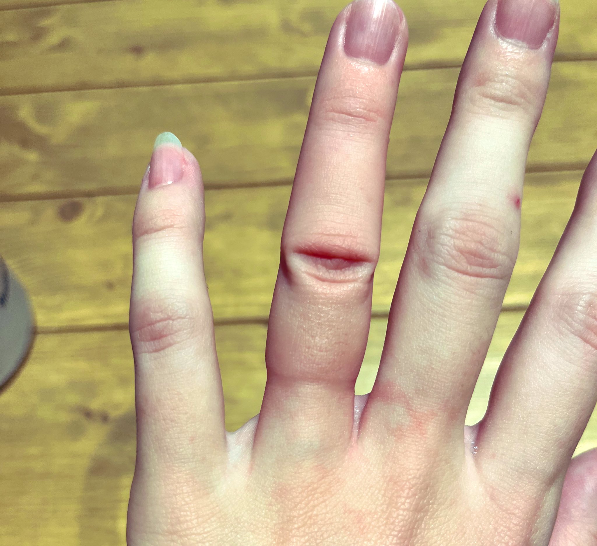 たろちゃん 7m 昨日どなたかのツイートで 妊娠29週くらいには結婚指輪外しておかないと 病院で外す必要が出た時にむくみ で取れず指輪切断される場合があるって見て 私は体重増加妊婦だしそろそろ外した方がいいかなと頑張って取ったんだけど 死ぬ