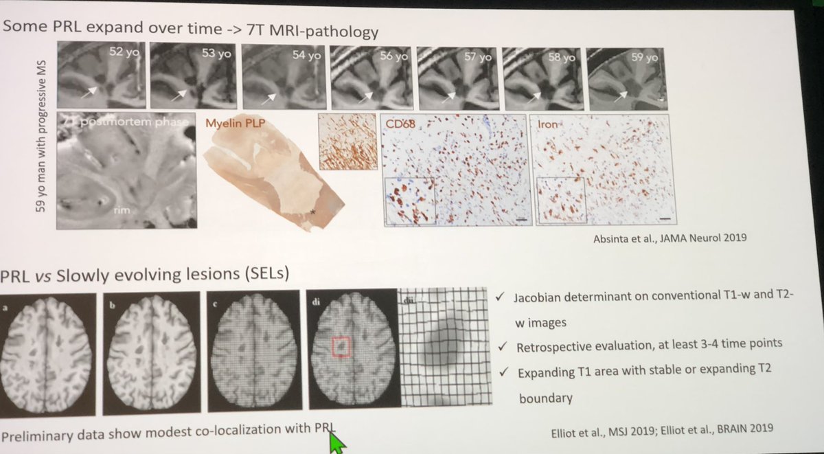 drbarrysinger's tweet photo. Absinta: Paramagnetic Rim Lesions #PRLs on MRI associated with early disability and failure of lesion repair.  Some PRLs can resolve however. #ACTRIMS https://t.co/KcMY43B7tJ