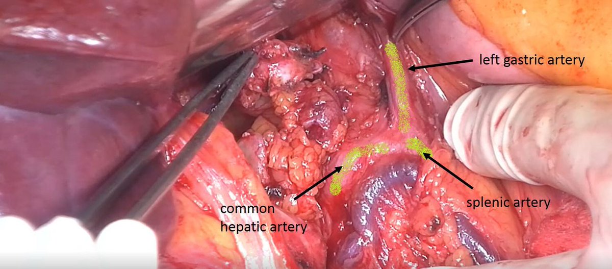 IJGConline's tweet photo. Weekend is here 😃 ! Time to relax with a ☕ and enjoy a surgical video 📹 and explore skills that takes us to #CGR
Celiac LN dissection and peri-hepatic peritonectomy in 10 steps
🔗 https://t.co/2elRYahge6 @ESGO_society @IGCSociety @IJGCfellows @pedroramirezMD #SoMeSurgery https://t.co/7A5HwBM0jN