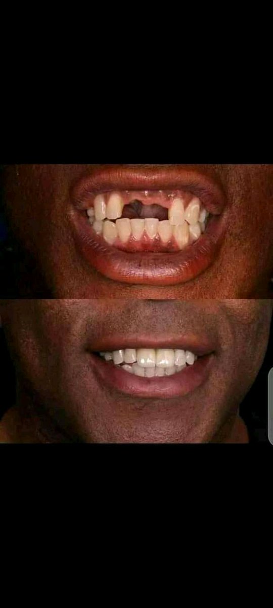 SserembaDental's tweet photo. We have all teeth replacement options available for you! Make yourself an appointment with us π Do you love it ππ
#Bridge
#PermanentReplacement
#DrTeeth
#AskTheDentalSurgeon https://t.co/1paQSssSXz