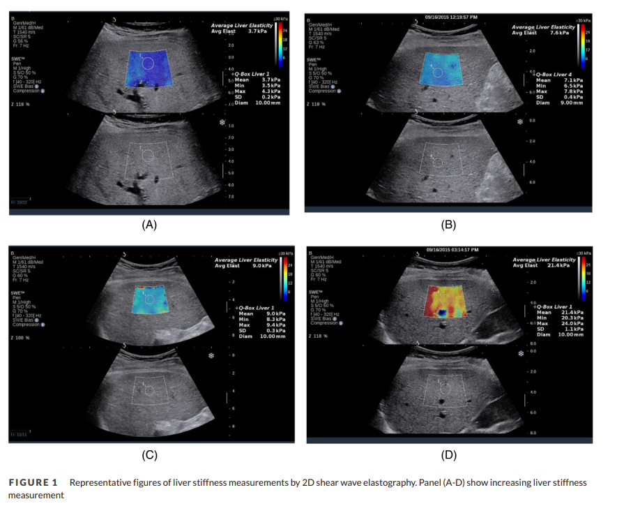 Liver elastography is a good biomarker of venous congestion and is associated with 🫀failure outcomes: study from <a href="/NishahPanchani/">Nishah Panchani MD</a> and <a href="/AsraniSumeet/">Sumeet Asrani</a> 

When will we see trials of change in liver elastography as target for CHF hospitalization? Or have we?
pubmed.ncbi.nlm.nih.gov/34817905/