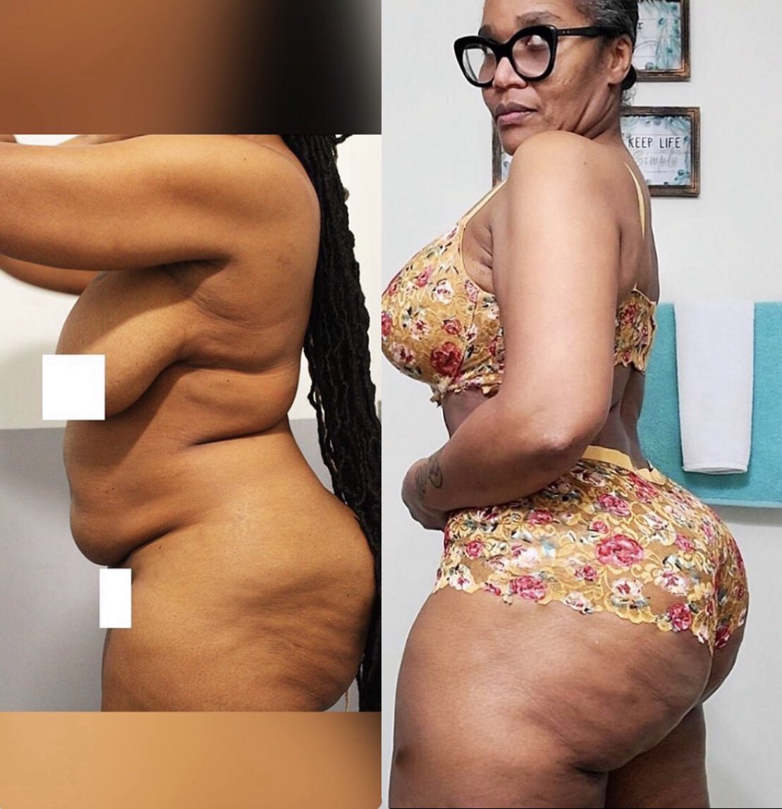 The Cosmetic Lane on X: This Doll started her Lipo & BBL journey at 52 ✨   / X