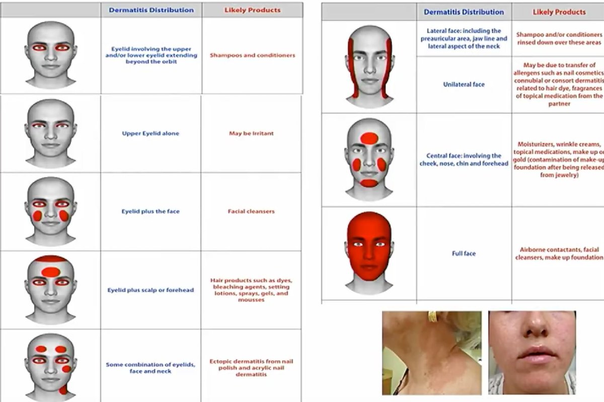 Beautiful slide on contact dermatitis distribution by Dr. Luz Fonacier. #AAAAI22